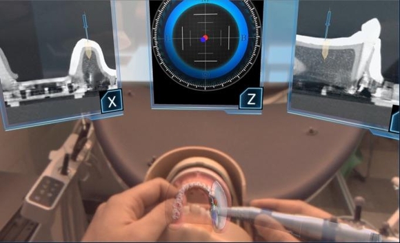 복합현실 기술을 도입해 실제 환자 환부 위에 각종 정보를 표시해 구강시술을 돕는 ‘치과 치료 시뮬레이션 시스템’. / 리얼라이즈모바일커뮤니케이션 캡처