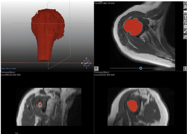어깨와 무릎에 MRI에 AI 기술을 도입하면 수시간에서 수일이 걸리던 뼈, 연골, 근육 조직의 분류와 질환 판독이 가능해집니다. / Medicap IP 제공