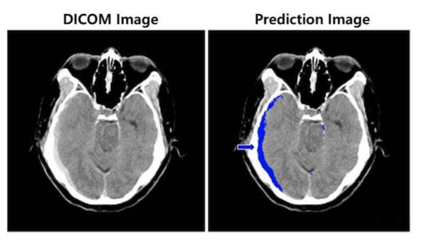 (왼쪽부터) 뇌출혈이 의심되는 환자의 뇌 CT 영상과 뇌출혈 영상 판독 AI모델이 출혈 병변(화살표) 존재와 위치를 식별한 영상/SK㈜ C&C