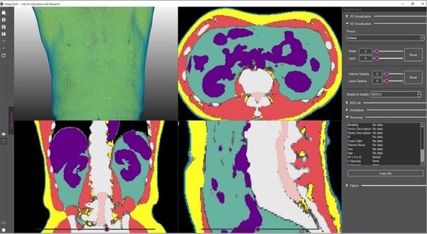 딥캐치를 이용한 체성분 분석 화면 / 메디컬아이피