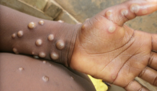  원숭이두창에 걸린 나이지리아 환자의 손과 팔 / 세계보건기구